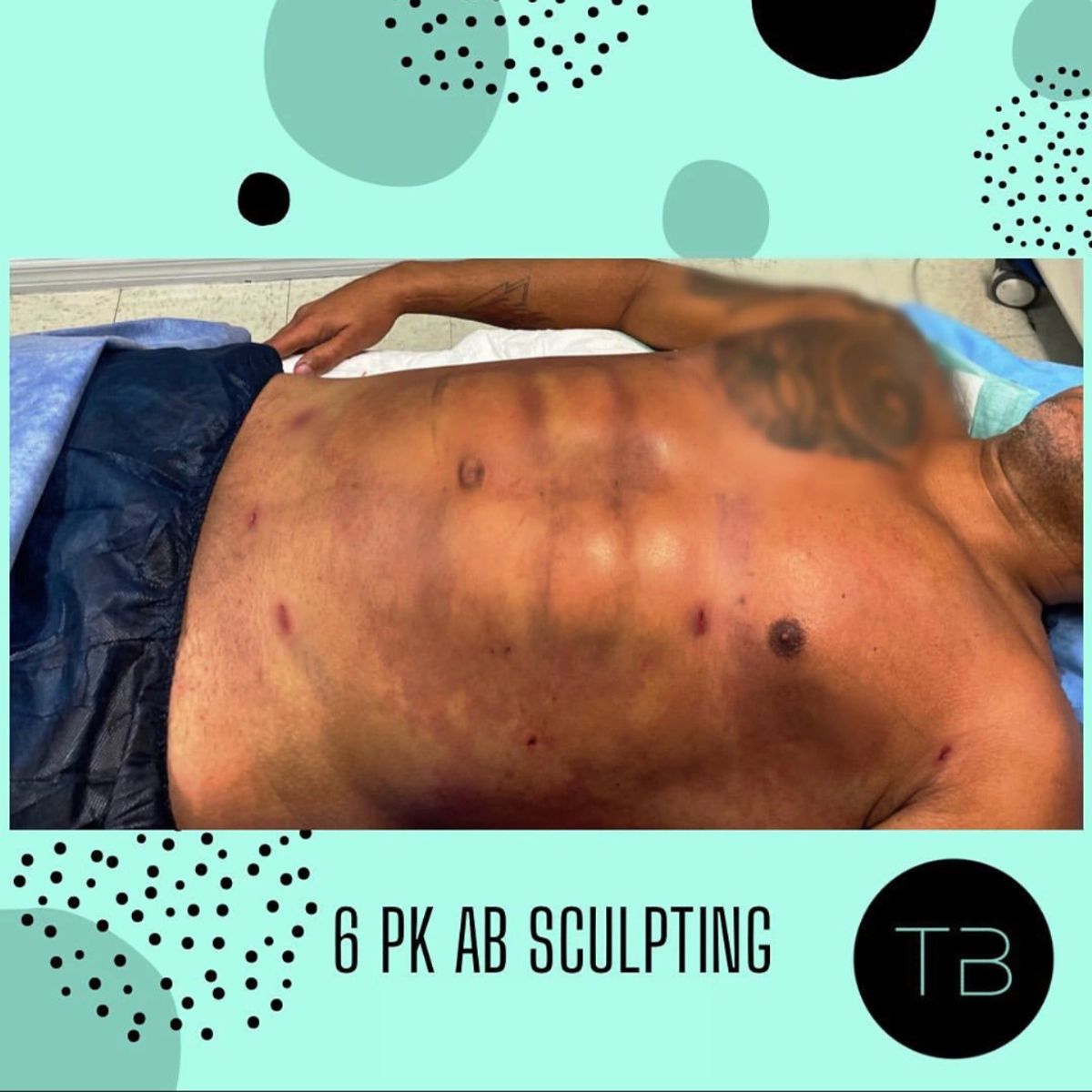 Before and after body sculpting showing 6 pack ab sculpting immediately after surgery.