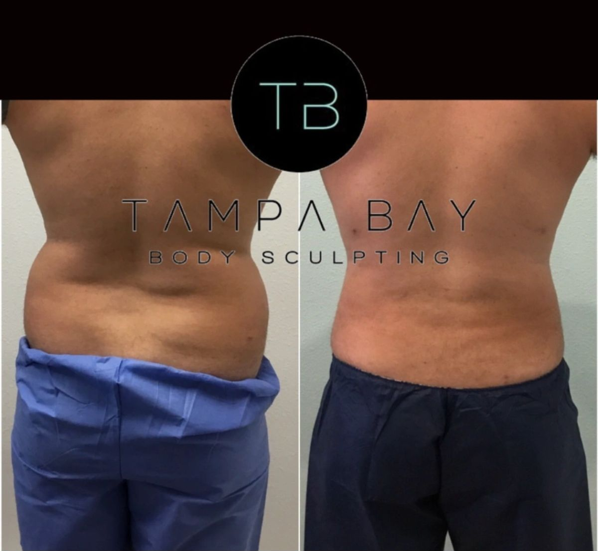Before and after body sculpting showing Lipo 360 with fat removed from the flanks.