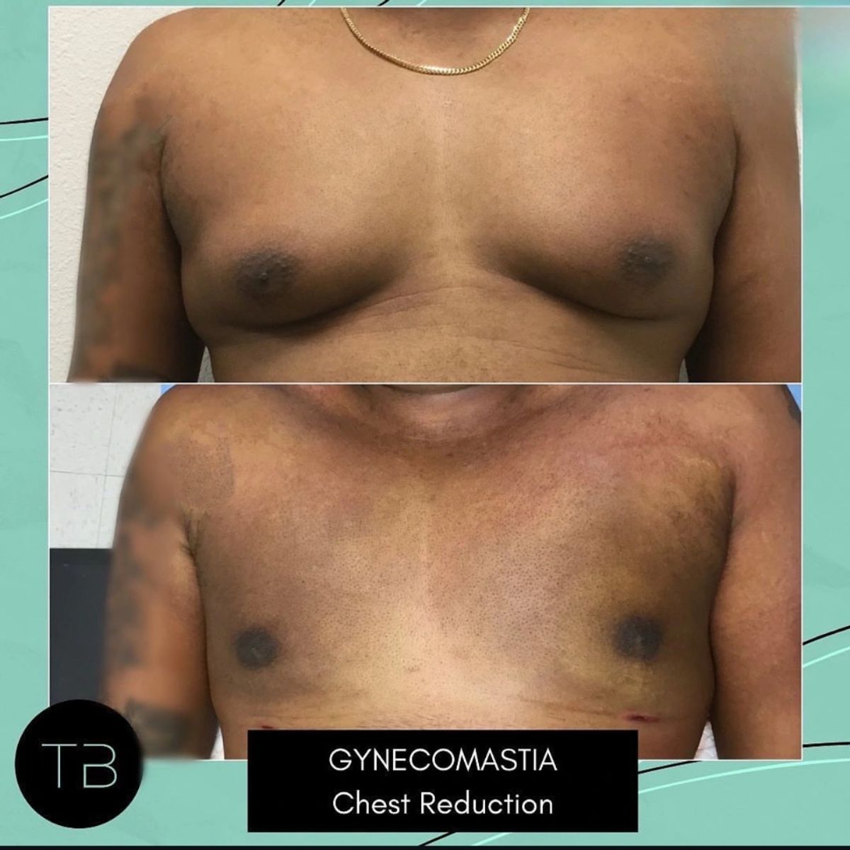 Before and after body sculpting showing gynecomastia chest reduction.