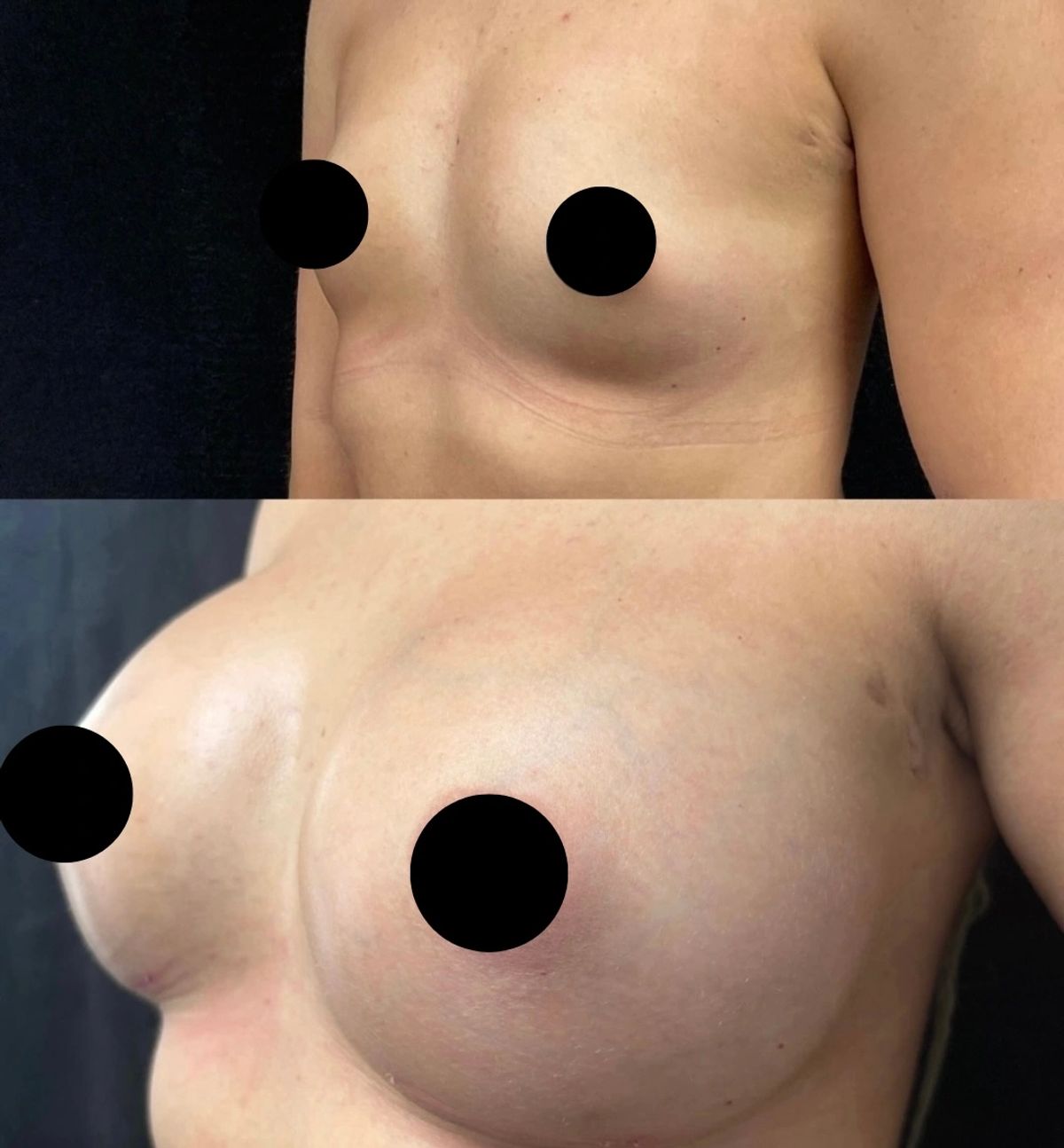 Before and after images of breast augmentation surgery.