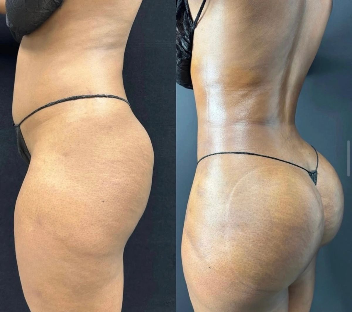 Before and after body contouring results with slim waist, Brazilian butt lift (BBL), and enhanced curves.