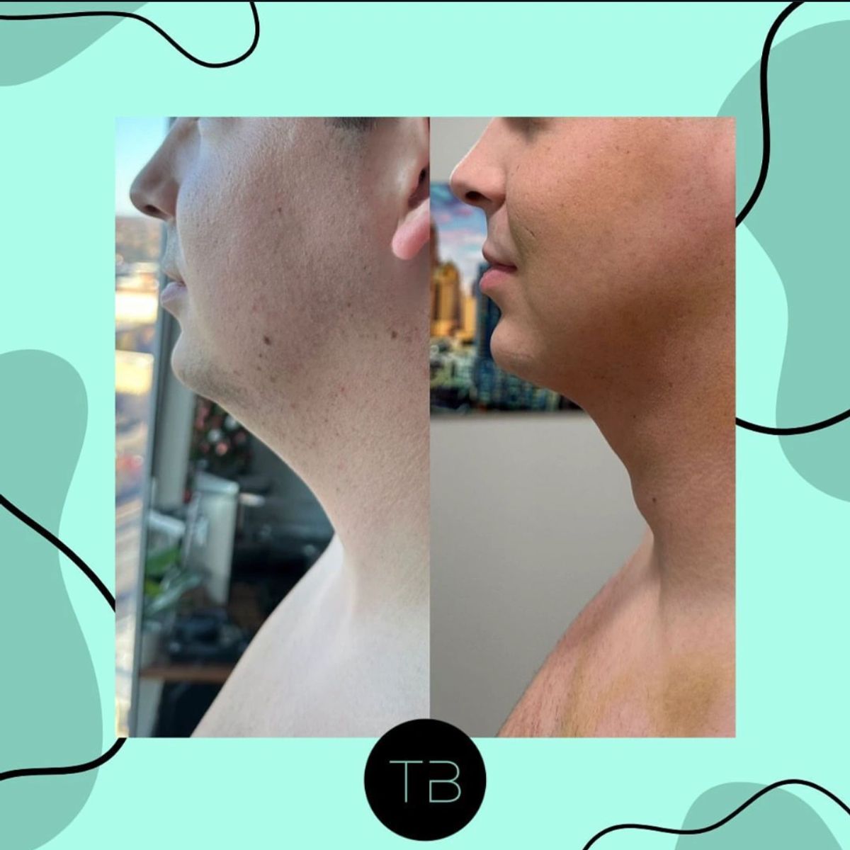 Before and after body sculpting showing chin liposuction.