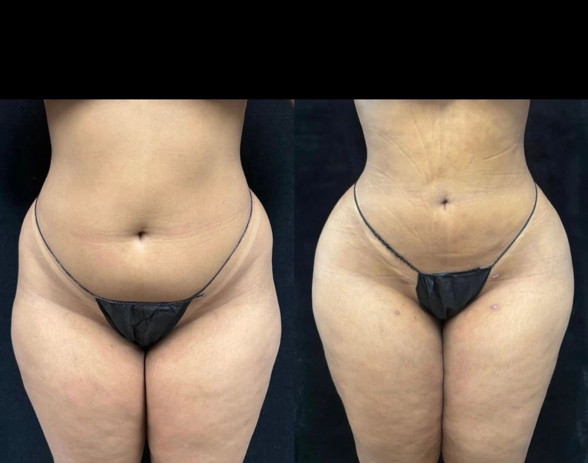 Before and after body contouring showing a slimmer waist and hip dips filled with brazillian butt lift BBL.