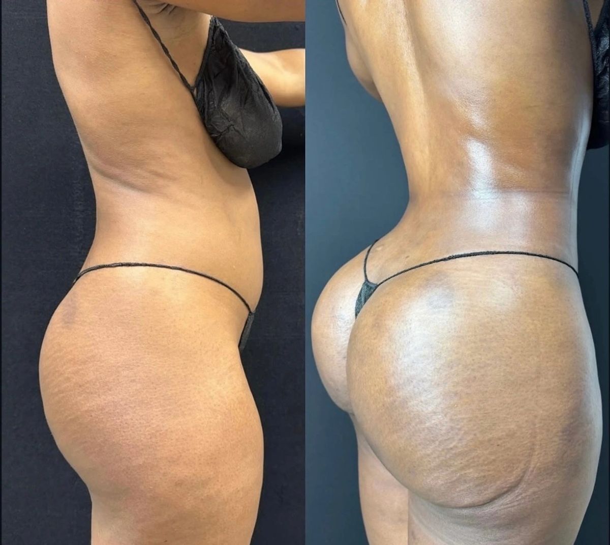 Before and after photos showing female body sculpting with Lipo 360, waist contouring, and Brazilian butt lift (BBL).