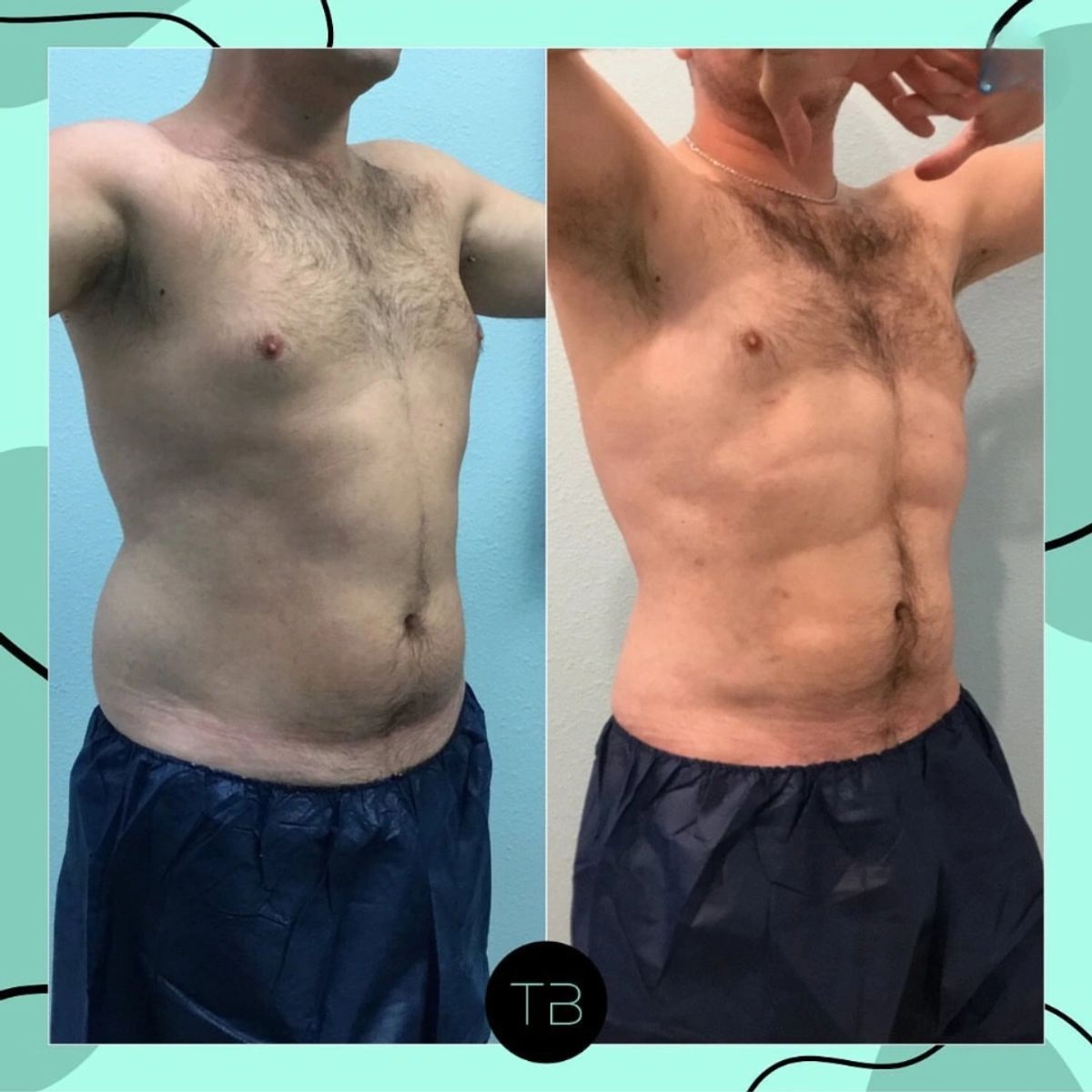 Before and after body sculpting showing Lipo 360 with 6 pack ab sculpting.