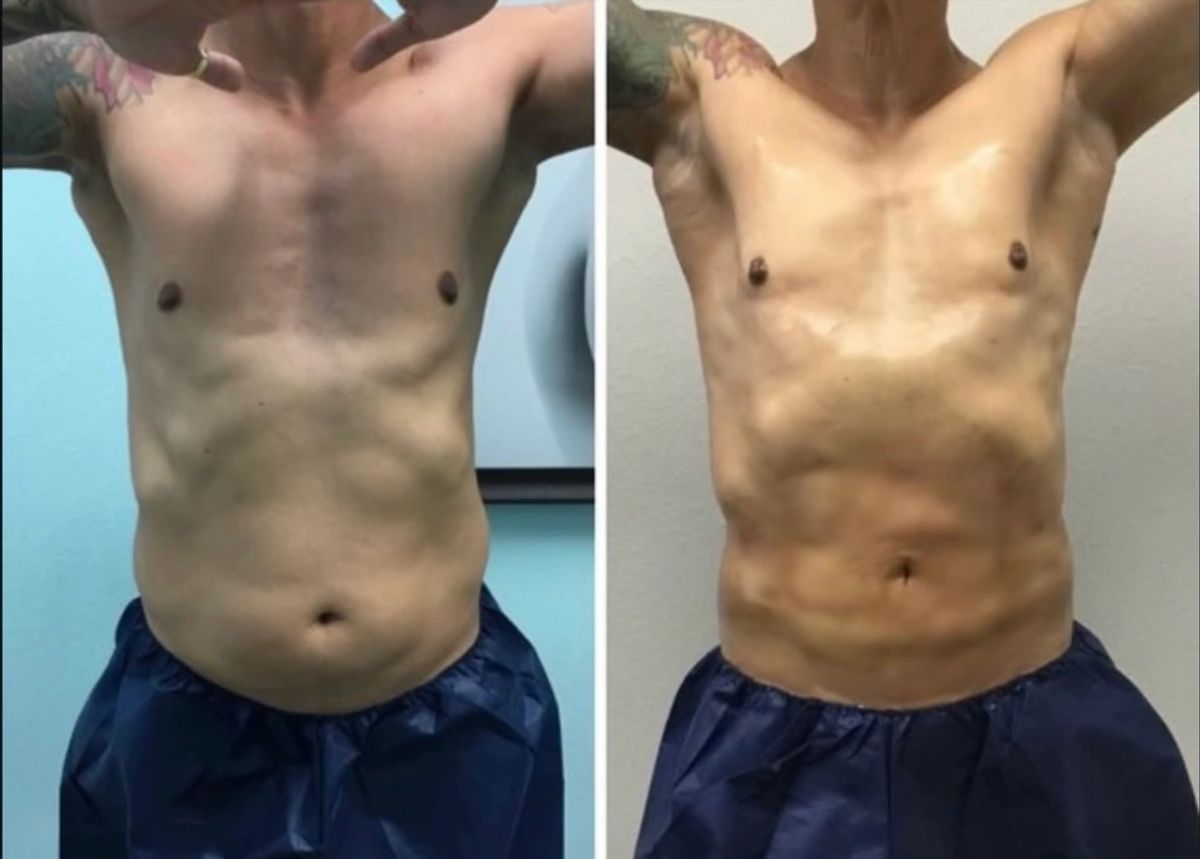 Before and after body sculpting showing Lipo 360 with 6 pack abdominal definition.