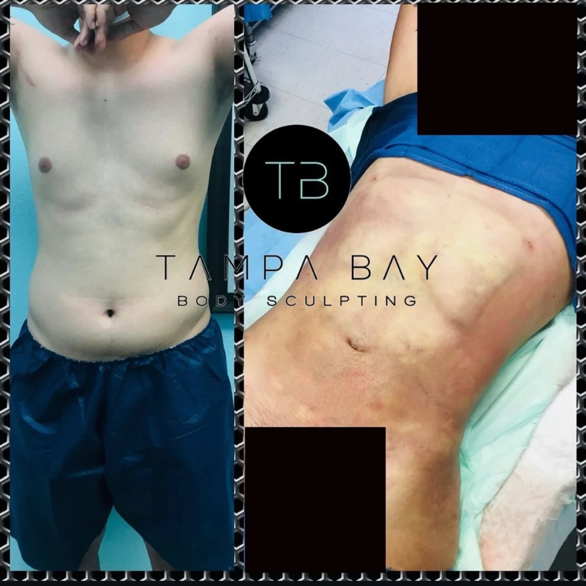 Before and after body sculpting showing 6 pack ab sculpting and a toned, defined abdomen.