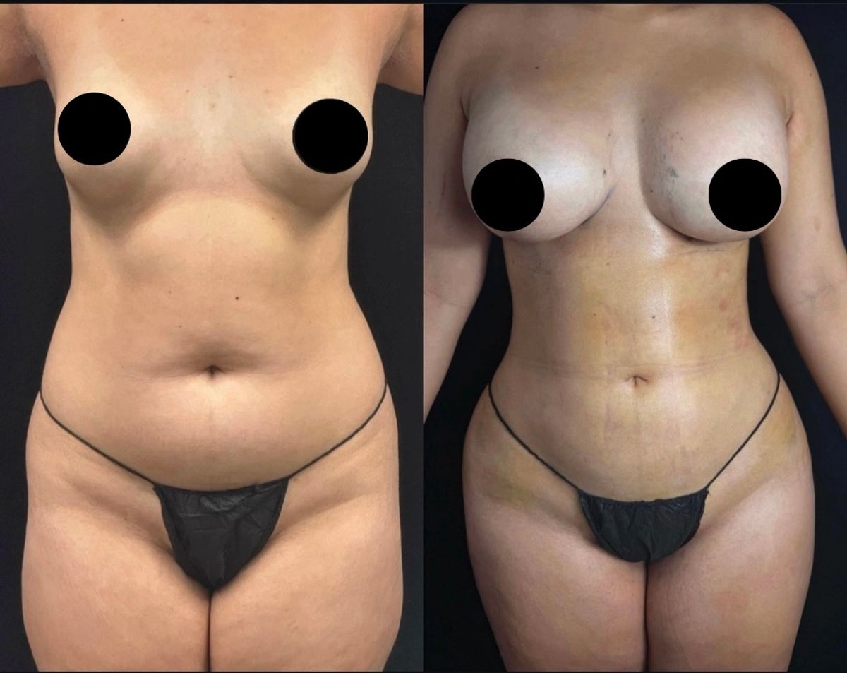 Before and after body contouring and breast augmentation surgery.