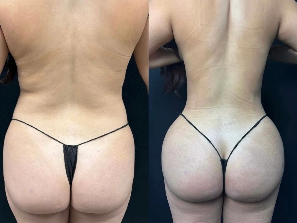 Before and after body contouring showing waist contouring with Brazillian Butt Lift BBL enhancement