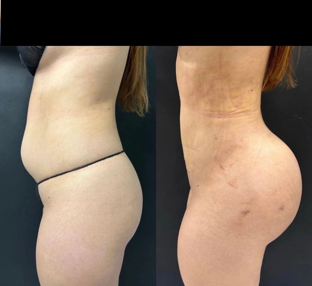 Before and after body contouring showing a slimmer waist and brazillian butt lift BBL enhancement