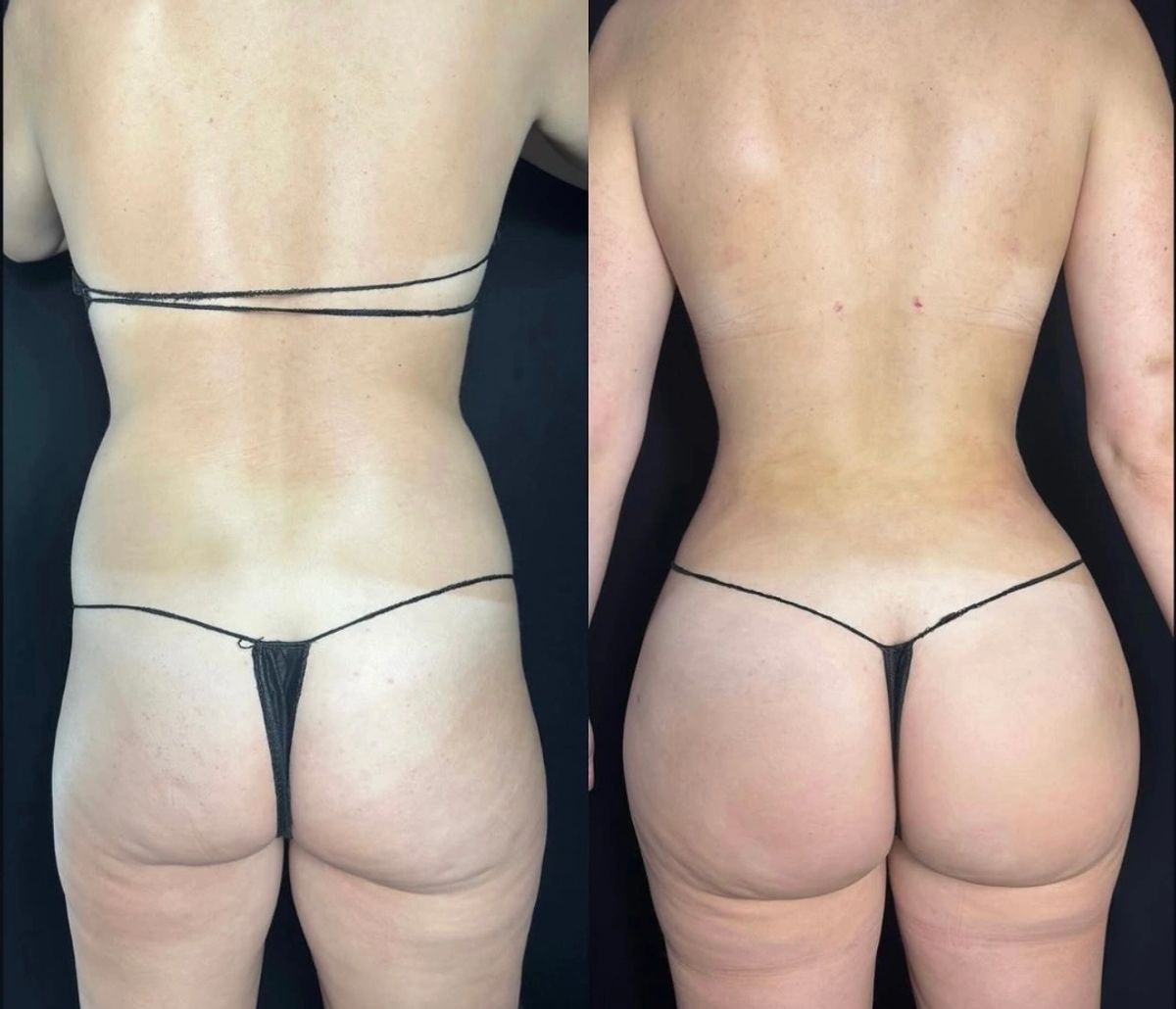 Before and after body contouring showing a slimmer waist, hip dips filled in, and Brazilian butt lift (BBL) enhancement.