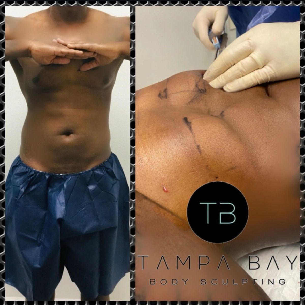 Before and after body sculpting showing 6 pack ab sculpting and a toned, defined abdomen.