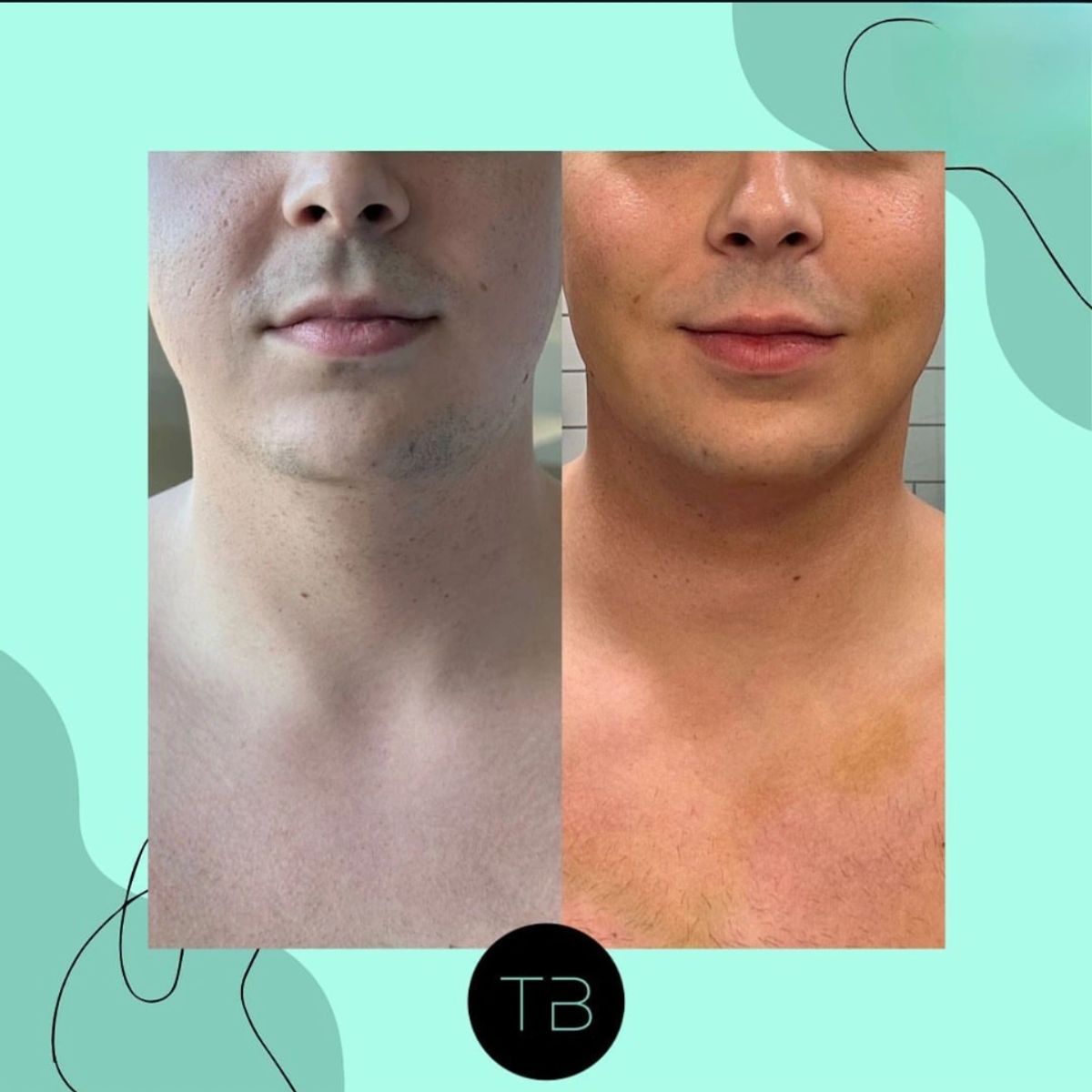 Before and after body sculpting showing chin liposuction.
