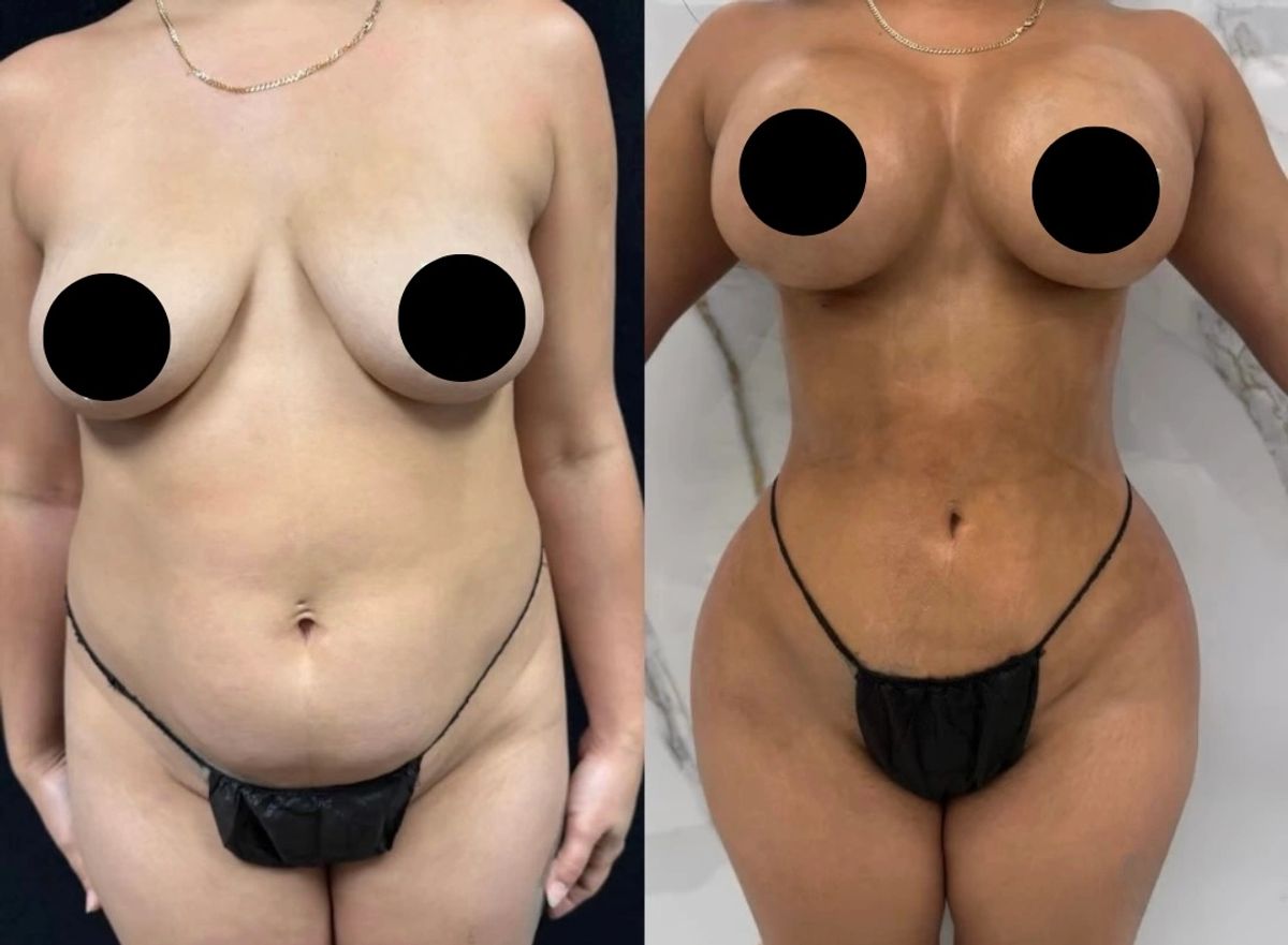 Before and after photo showing breast augmentation, breast lift, and Lipo 360 with waist contouring.