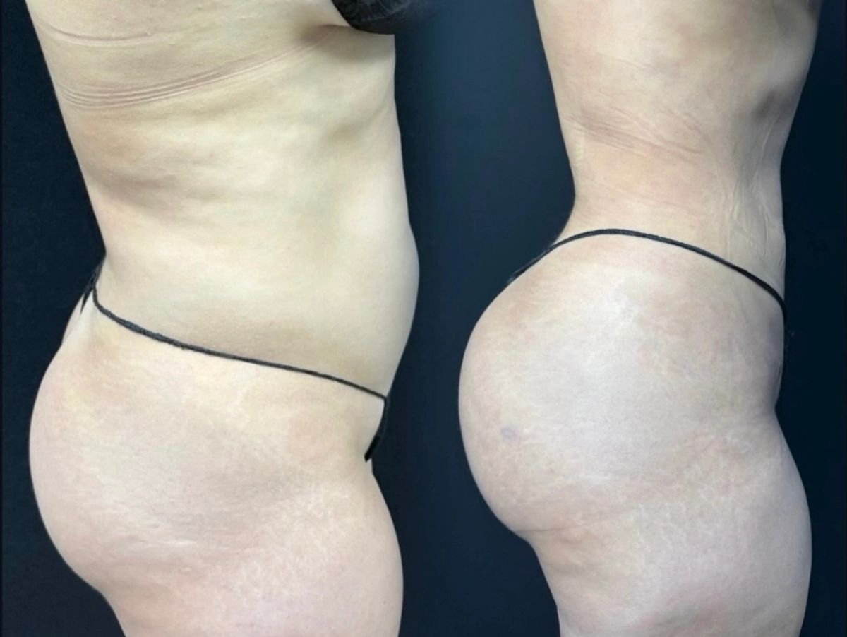 Side-by-side comparison of waist contouring with Lipo360 and Brazillian butt lift BBL. Flat belly