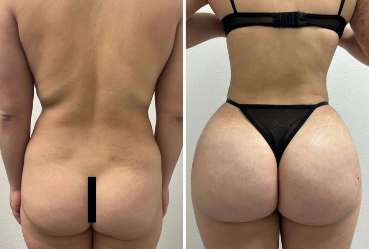 Before and after photos showing Lipo 360 with waist contouring and Brazilian butt lift (BBL) transformation.