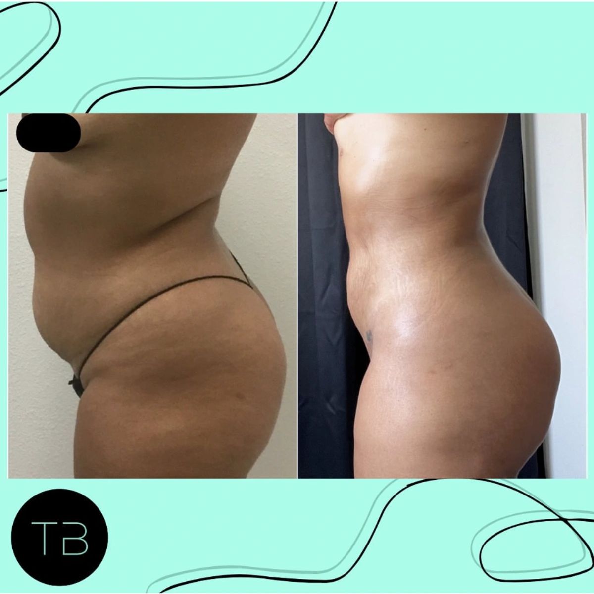 Side-by-side before and after photos showing body contouring results. Lipo360, waist contouring