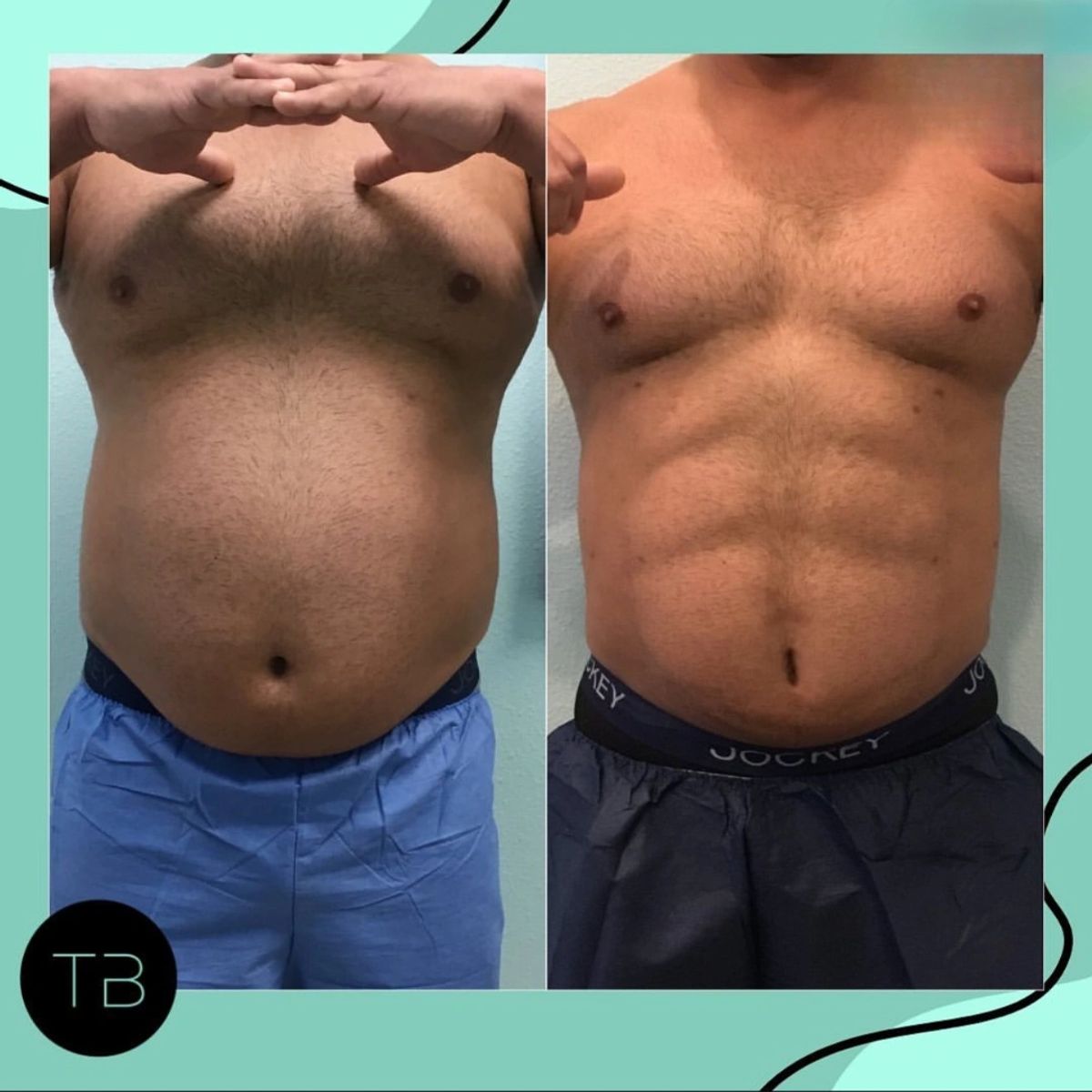 Before and after body sculpting showing Lipo 360 with 6 pack ab sculpting.