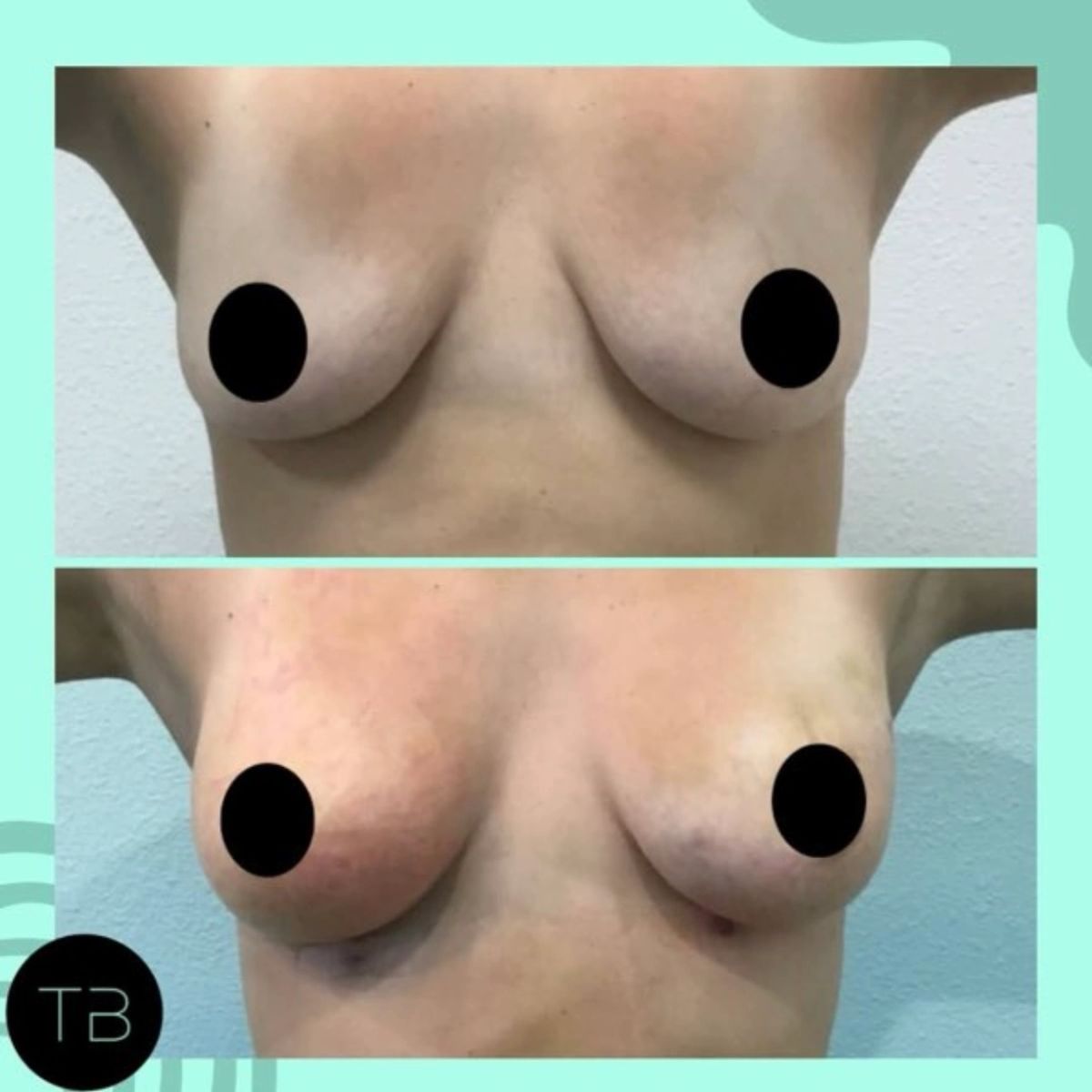 Before and after breast augmentation photos.