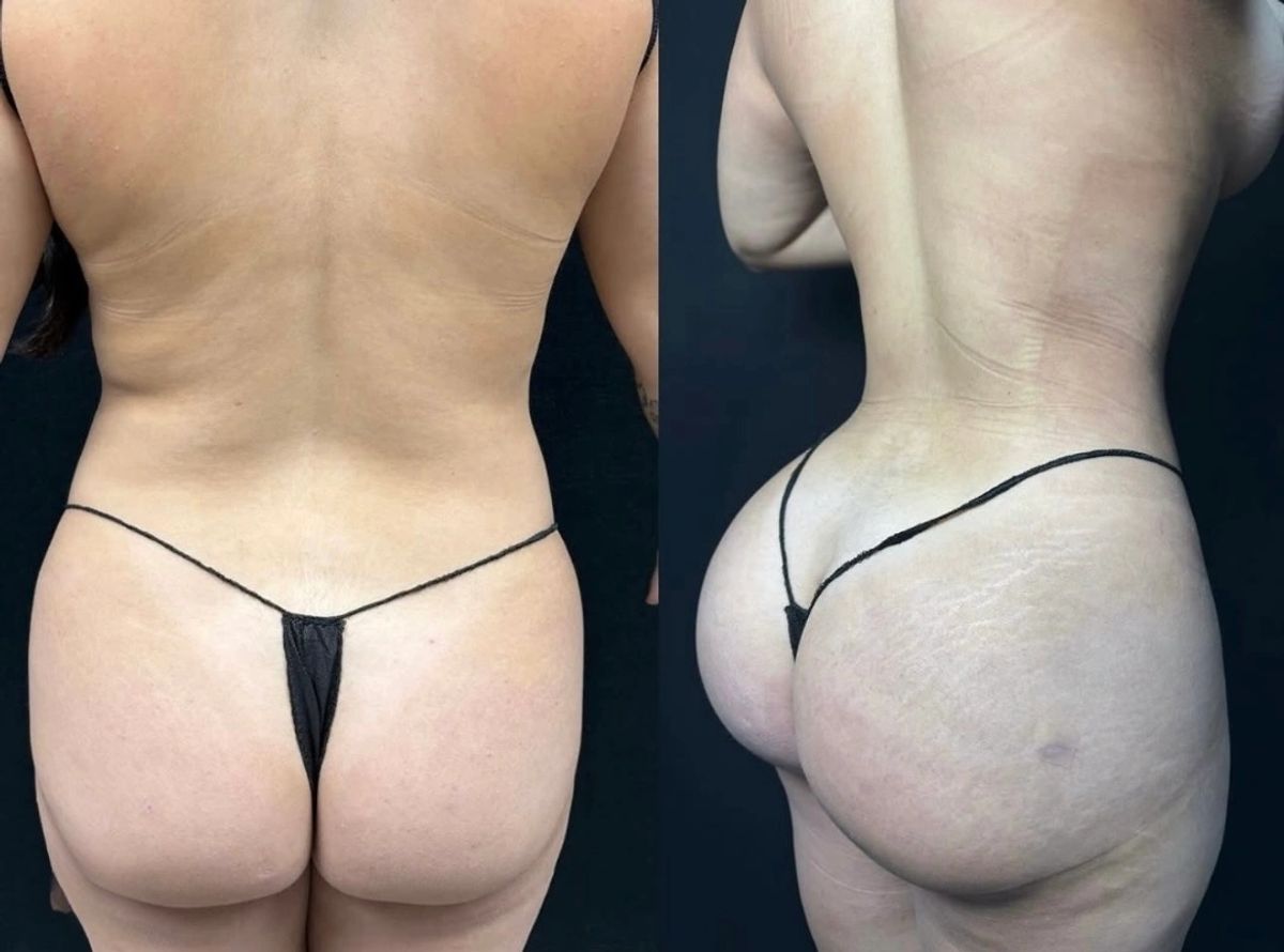 Before and after photos showing waist contouring and body contouring with Brazilian butt lift (BBL) results.