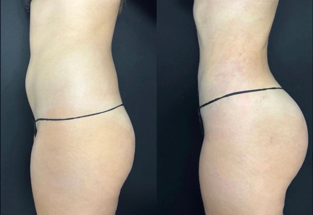 Side-by-side before and after photos showing waist contouring and Lipo 360 body sculpting results.