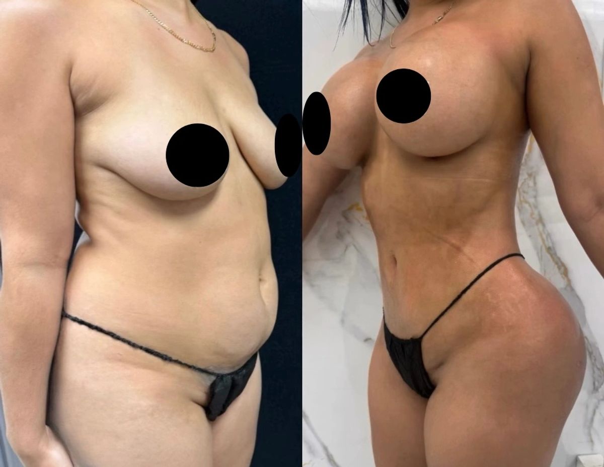 Before and after photo showing breast augmentation, breast lift, and Lipo 360 with waist contouring.