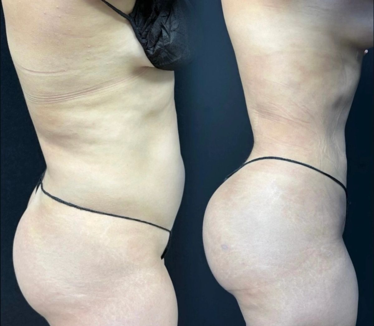 Side-by-side before and after photos showing female body contouring results with flat stomach, slim waist, brazillian butt lift enhancement