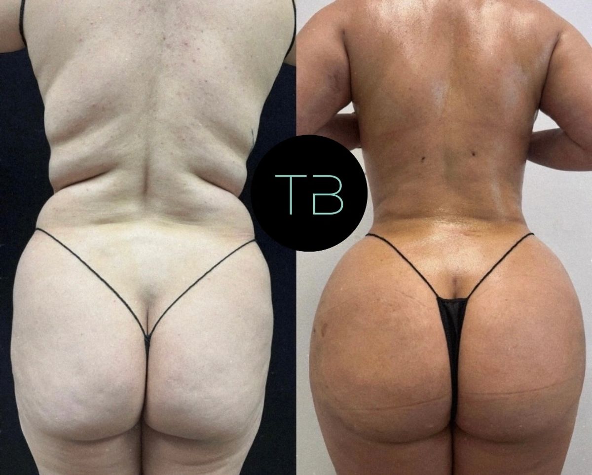 Before and after photos showing waist contouring and Brazilian butt lift (BBL) with hourglass silhouette.
