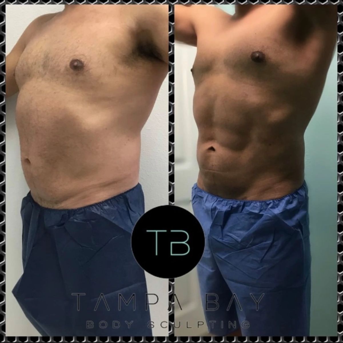 Before and after body sculpting showing Lipo 360 with 6 pack ab sculpting.