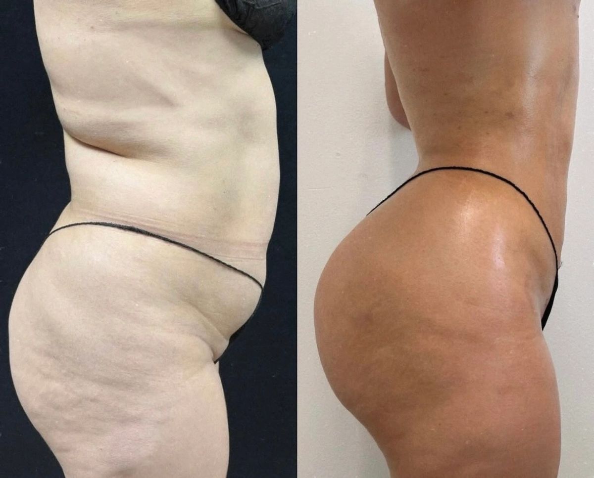Side-by-side before and after photos showing Lipo 360, waist contouring, flat stomach, and BBL transformation.