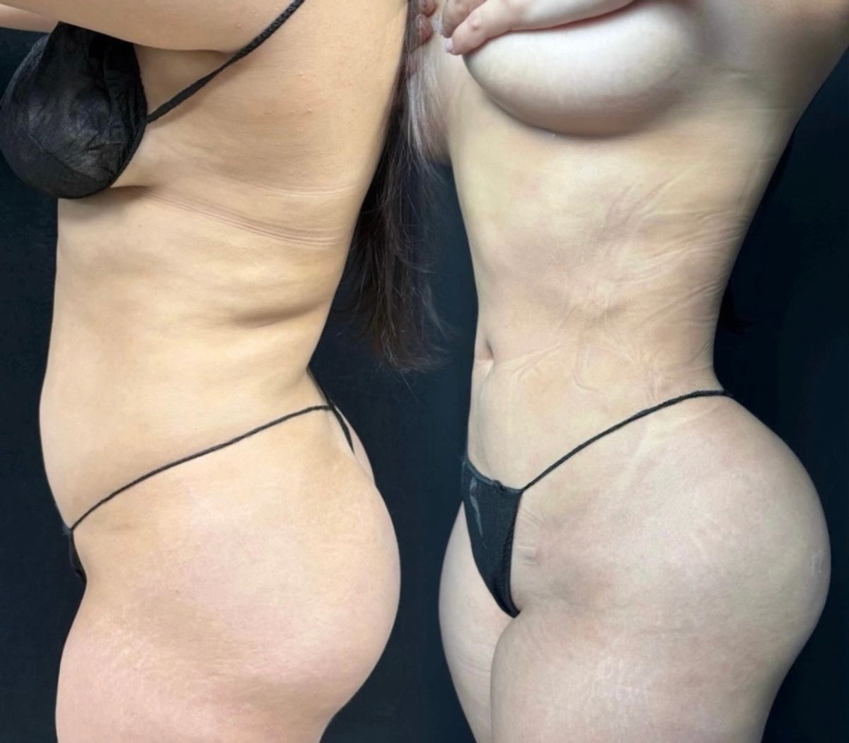 Side-by-side before and after photos showing female body contouring results with flat stomach, slim waist, brazillian butt lift enhancement.