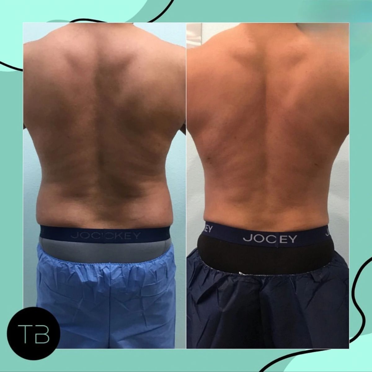 Before and after body sculpting showing Lipo 360 with fat removed from the flanks.