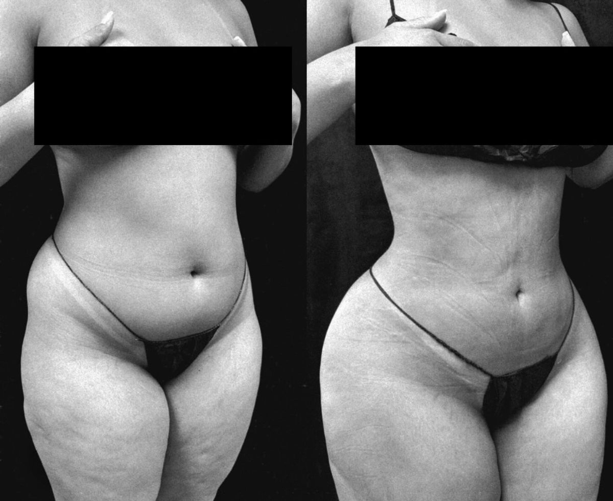 Before and after body contouring showing slimmer waist and flat stomach with hip dips filled in Brazillian Butt lift BBL