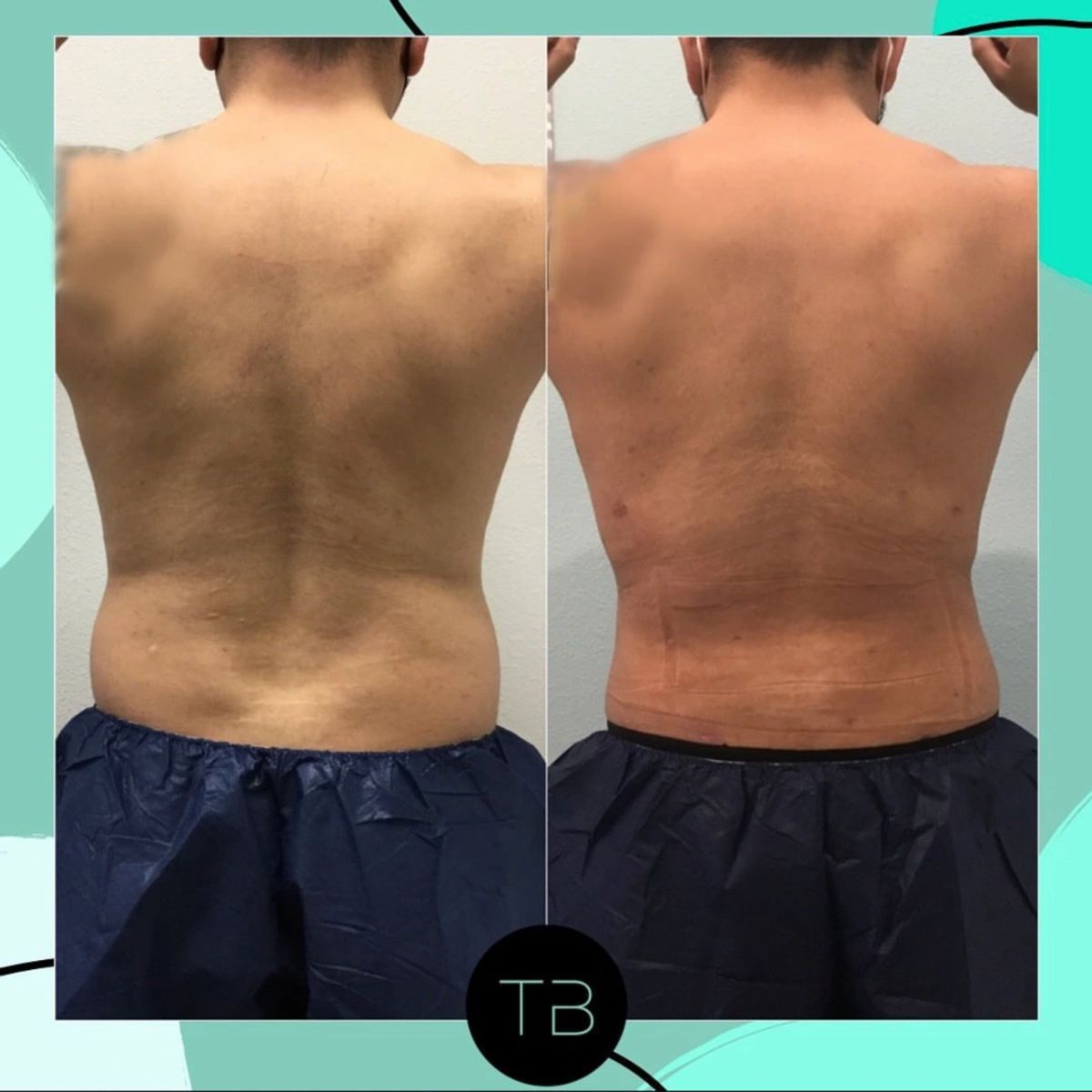 Before and after body sculpting showing Lipo 360 with fat removed from the flanks.