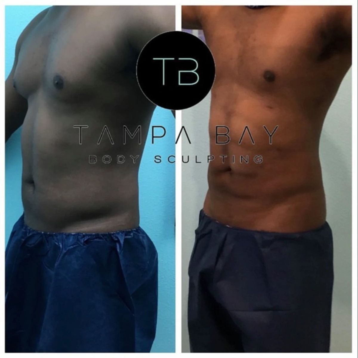 Before and after body sculpting showing Lipo 360 with 6 pack ab sculpting and a toned abdomen transformation.