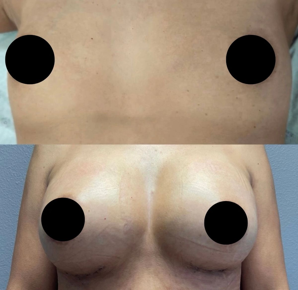 Before and after breast augmentation results.