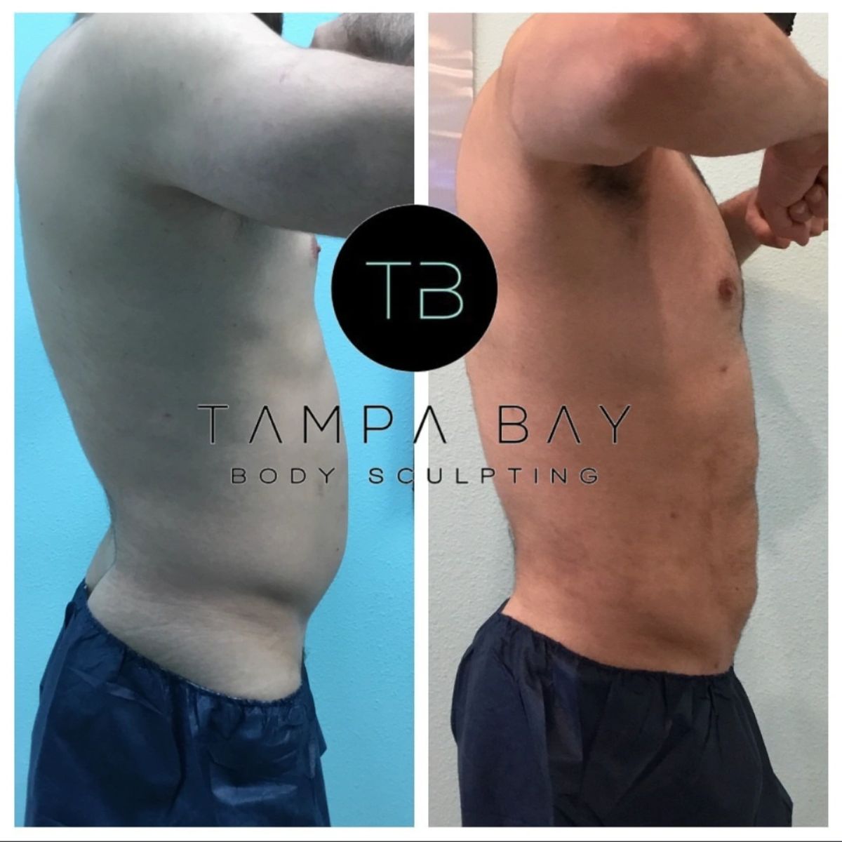 Before and after body sculpting showing 6 pack ab sculpting and a toned, defined abdomen.