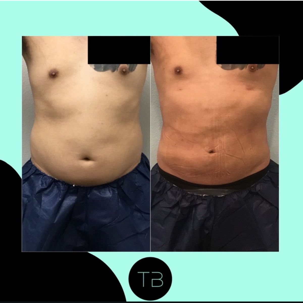 Before and after body sculpting showing Lipo 360 with abdominal fat and flanks removed.