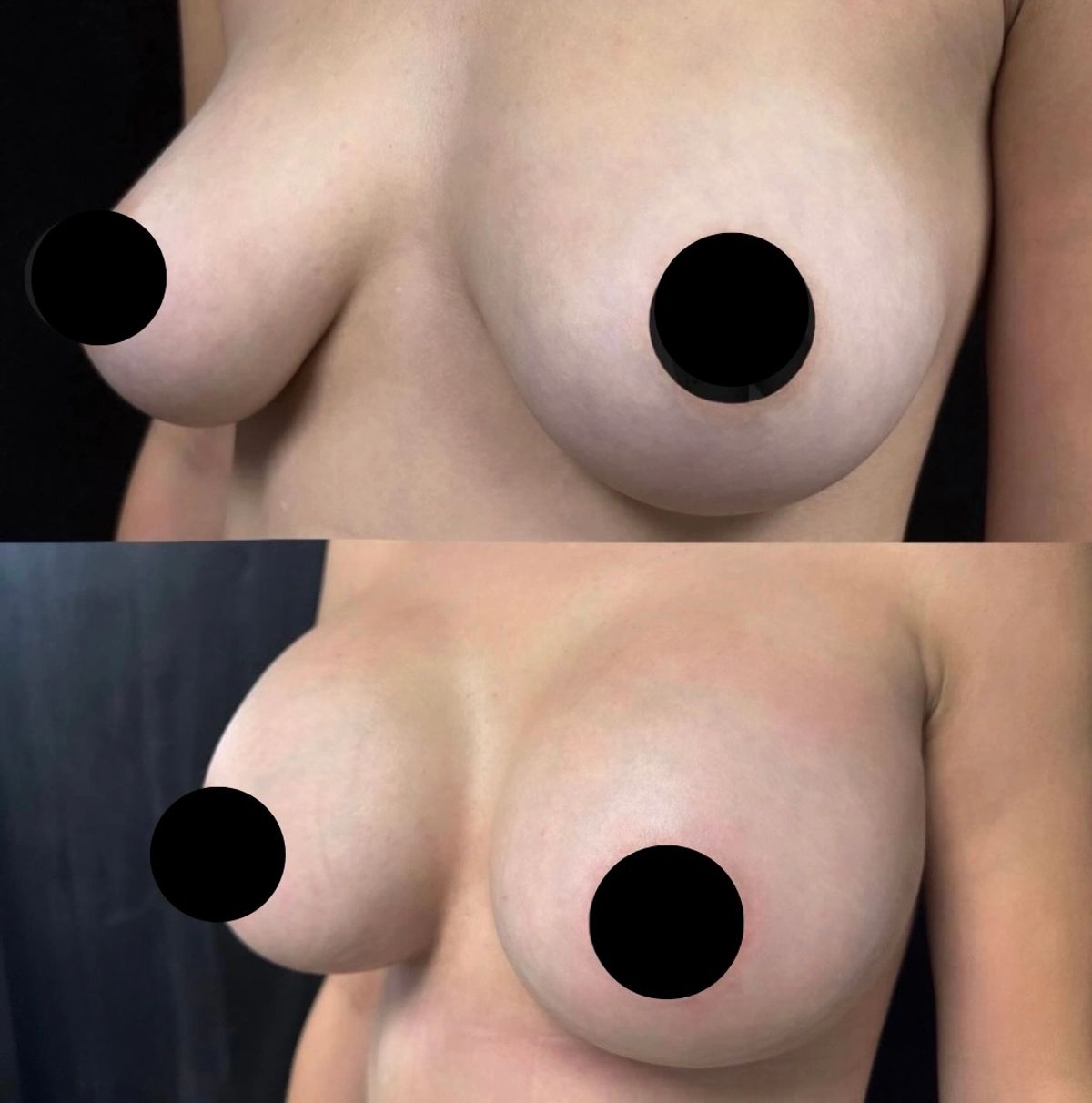 Before and after breast augmentation comparison showing enhanced volume and shape.