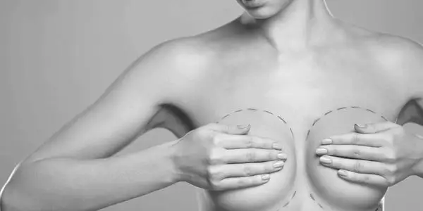 Woman representing breast revision surgery in Tampa Bay